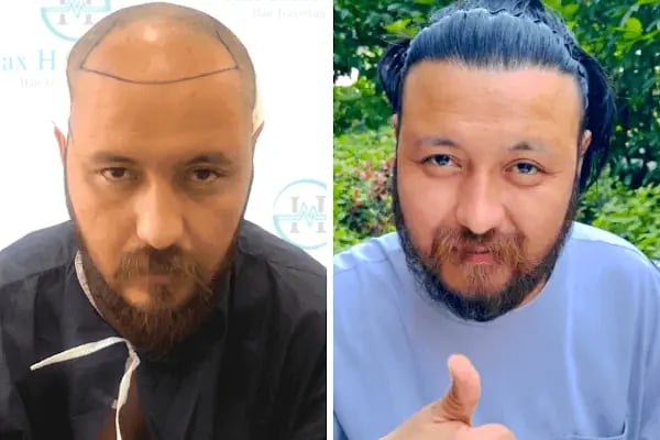Max Hair Center - Resim 14