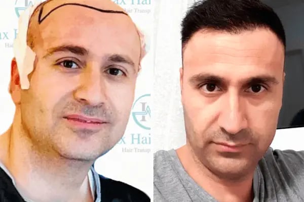 Max Hair Center - Resim 18